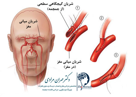 عمل جراحی بازسازی عروق