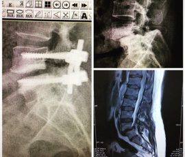 نمونهای از جراحی و اصلاح کامل سرخوردگی مهره توسط دکتر مرادی