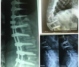 بیمار خانم میانسال با سابقه جراحی دیسک L1-L2 سه سال قبل که با شکایت کمر درد ،کاهش قد و بی حسی اندام های تحتانی مراجعه نمود پس از بررسی با تشخیص کیفوز جانکشنال و تنگی کانال تحت عمل جراحی قرار گرفت . دفورمیتی به طور کامل اصلاح گردید.