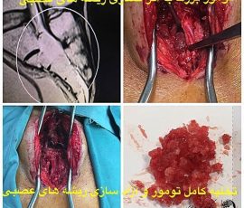 بیمار آقای ۴۲ ساله با شکایت درد لگن از ۳ ماه قبل و سپس بی حسی بین پاها و بی اختیاری ادرار و مدفوع مراجعه که پس از بررسی با تشخیص کوردوم استخوان ساکروم تحت عمل جراحی و تخلیه کامل تومور گردید پس از عمل علایم بیمار بهبود یافته و برای درمان تکمیلی ارجاع داده شد