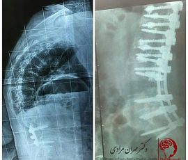خانم ۶۷ ساله مورد جراحی کمر چندین سال قبل که با شکایت درد ضعف عضلانی مراجعه نمود پس از بررسی کیفوز (قوز) بسیار شدید به همراه اسکولیوز زیاد داشت که در یک عمل جراحی حساس دفورمیتی ستون مهره اصلاح ، بدلیل پوکی استخوان از سیمان استخوان استفاده شد و همچنین پیج بلند لگن برای بیمار تعبیه گردید