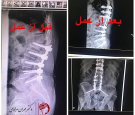 بیمار آقای ۸۲ ساله که یکسال قبل بدلیل سرخوردگی مهره و تنگی کانال تحت عمل جراحی قرار گرفته بود مجدد با شکایت درد لگن و پشت مراجعه و پس از بررسی متوجه شکستگی مهره دوم و کیفوز جانکشنال به همراه شل شدگی پیچ اول ساکروم شدیم . بیمار مجدد تحت عمل جراحی تعبیه پیچ بلند لگن از طریق مهره دوم ساکروم و اصلاح کیفوز جانکشنال قرار گرفت.