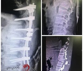 شکستگی دررفتگی مهره T12-L1 به دنبال تصادف در آقای ۳۷ ساله
