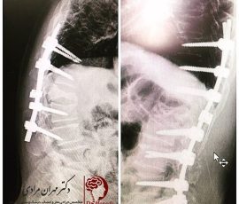 بیمار آقای میانسال با شکستگی مهره که ۳ ماه قبل در مرکز دیگری تحت عمل جراحی قرار گرفته بود به دلیل مصرف بالای سیگار و پوکی استخوان شدید دچار پیشرفت شکستگی و خروج پیچ کمری شده که مجدد تحت عمل جراحی اصلاح قوز با تکنیک PSO و اصلاح پیچ ها قرار گرفت