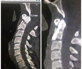 درمان شکستگی مهره دوم گردن با رویکرد قدامی گردن وبا استفاده از پیچ Lag در این روش بیمار مدت کوتاهی بعد از عمل ترخیص می گردد و هیچ گونه محدودیت حرکتی برای بیمار ایجاد نمیگردد.