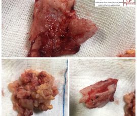 بیمار خانم میانسال با شکایت سر درد و ضعف اندام تحتانی که پس از بررسی با تشخیص مننژیوم مغز تحت عمل جراحی تخلیه کامل تومور قرار گرفت حین عمل یافته نادری داشت به طوریکه پس از باز کردن پرده مغزی قطعه بزرگ استخوانی روی تومور تشکیل شده بود و داخل سینوس وریدی اصلی مغز رفته بود هر دو ضایعه تخلیه و سینوس پک گردید
بیمار بدون نقص عصبی ترخیص گردید