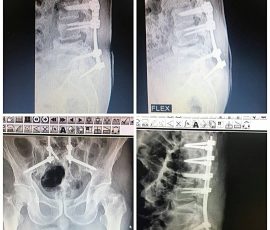 بیمار آقای ۶۴ ساله مورد شکستگی مهره دو سال قبل که در مرکز دیگر تحت عمل جراحی قرار گرفته بود بدلیل مصرف زیاد سیگار و جوش نخوردن استخوان و خروج پیچ های کمری دو نوبت تحت عمل جراحی قرار گرفته بود که مجدد پیچ ها از محل خود خارج شدند در نهایت بیمار با تکنیک جدید تحت عمل جراحی و تعبیه پیچ در لگن قرار گرفت.
