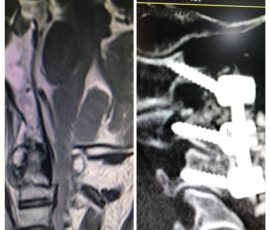درمان شکستگی مهره دوم گردن در خانم میانسال تعبیه پیچ در این مناطق با توجه به نزدیکی به شریان های مغزی بسیار حساس و پیچیده می باشد.