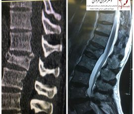 آقای ۶۵ ساله که بدنبال سقوط دچار شکستگی مهره اول کمری شده بود بدلیل درد زیاد وعدمپاسخ گویی به درمان حمایتی کاندید کیفوپلاستی گردید در این روش بدون برش ،بیهوشی و جراحی باز از طریق پوست وارد مهره شده و سیمان استخوان تزریق میگردد
درد بیمار پس از تزریق سیمان بهبود یافت و چند ساعت بعد ترخیص گردید