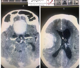 بیمار خانم ۸۰ ساله که بدنبال افت هوشیاری و پس از انجام سی تی مغز با تشخیص دو تومور مغزی بزرگ از نوع مننژیوم بستری گردید بدلیل کاهش هوشیاری امکان انجام ام آر آی نبود بیمار تحت عمل جراحی یکی از تومورها که ادم بیشتری داشت قرار گرفت جراحی تومور دوم پس از پایدار شدن شرایط بیمار انجام خواهد شد