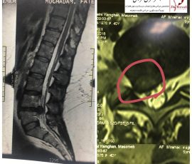 بیمار خانم جوان با درد شدید پای راست و با تشخیص پارگی دیسک کمر تحت عمل جراحی قرار گرفت جراحی با حداقل برش پوست کمر انجام ودیسک به طور کامل تخلیه گردید .