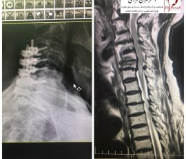 بیمار آقای ۷۸ ساله با فلج نسبی هر ۴ اندام بستری و با تشخیص تنگی دفورمیتی بسیار شدید نخاع گردنی بستری گردید با توجه به سن و تنگی شدید ابتدا تحت عمل جراحی خلفی گردن قرار گرفت ، نقص عصبی بیمار به طور قابل توجه بهبود یافت پ بیمار راه اندازی گردید تصمیم گیری در مورد جراحی از قدام گردن پس از سه ماه گرفته خواهد شد