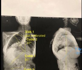 جراحی اسکولیوز بسیار شدید دختر ۱۲ ساله