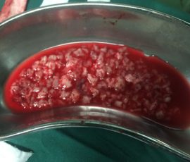 بیمار شیرخوار ۲۰ ماهه با شکایت تاخیر تکلم , راه رفتن و در نهایت فلج دست راست که پس از بررسی با تشخیص تومور بزرگ مغزی توسط دکتر مرادی جراحی گردید پس از عمل علائم بیمار بهبود و با توجه به گرید تومور جهت شیمی درمانی ارجاع گردید