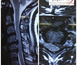 بیمار خانم میانسال با درد انتشاری به دست چپ که تحت عمل جراحی میکروسکوپی دیسک گردن قرار گرفت
