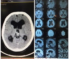 جراحی آندوسکوپی مغز توسط دکتر مرادی برای هیدروسفالی در بیمار با ضایعه عروقی با اثر فشاری روی سیستم بطن های مغزی