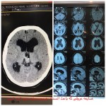 جراحی آندوسکوپی مغز توسط دکتر مرادی برای هیدروسفالی در بیمار با ضایعه عروقی با اثر فشاری روی سیستم بطن های مغزی