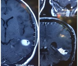 نمومه جراحی اپاندیموم مغز توسط تیم دکتر مرادی دکتر عبدلله زاده در بیمار جوان که تومور با حداقل برش و با استفاده از میکروسکوپ به طور کامل تخلیه گردید