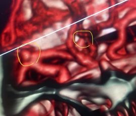 نمومه جراحی دو آنوریسم مغز در بیمار جوان توسط دکتر مرادی هر دو آنوریسم در یک جلسه و در یک عمل بسیار حساس کلیپ شدند و بیمار با حال عمومی خوب و بدون نقص عصبی ترخیص گردید