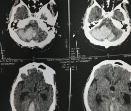 نمومه جراحی های خونریزی مغزی توسط دکتر مرادی و تخلیه کامل خونریزی