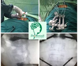 نمونه ای از جراحی کیفوپلاستی در بیمار با دو شکستگی مهره که بدون بیهوشی عمومی انجام گرفت