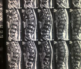 نمونه تنگی کانال نخاع و کیفوز مادرزادی توسط تیم استاد میری و دکتر مرادی
بیمار مبتلا به بیماری کوتاهی قد مادرزادی و کیفوز (قوز) که مبتلا به ضعف اندام تحتانی شده بود . عمل حساس جراحی اصلاح دفورمیتی با مانیتورینگ عصبی انجام گرفت نخاع کاملا آزاد و دفورمیتی اصلاح گردید چند هفته بعد از عمل نقص عصبی بهبود و بیمار بدون کمک راه اندازی گردید