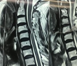 نمونه جراحی دیسک گردن توسط دکتر مرادی در خانم میانسال با درد انتشاری دست و اختلال راه رفتن به دلیل آسیب نخاع این عمل حساس با استفاده از میکروسکوپ انجام گرفت و اغلب علایم بیمار بعد از عمل بهبود یافت