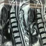 نمونه جراحی دیسک گردن توسط دکتر مرادی در خانم میانسال با درد انتشاری دست و اختلال راه رفتن به دلیل آسیب نخاع این عمل حساس با استفاده از میکروسکوپ انجام گرفت و اغلب علایم بیمار بعد از عمل بهبود یافت