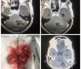 نمونه جراحی متاستاز سرطان تیروئید به دو محل مختلف در مغز توسط دکتر مرادی که هر دو متاستاز در یک جلسه خارج و بیمار جهت رادیوتراپی ارجاع داده شد