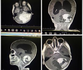 نمونه جراحی مدولوبلاستوم در کودک ۳ ساله که توسط تیم جراحی دکتر مرادی و دکتر عبدلله زاده تحت عمل جراحی تخلیه کامل تومور قرار گرفت بعد از عمل و پس از تایید پاتولوژی بیمار برای رادیوتراپی و کموتراپی ارجاع داده شد