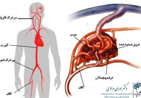 آمبولیزاسیون-اندوواسکولار