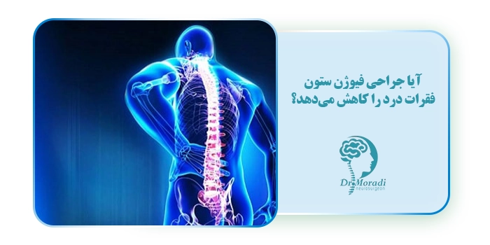آیا جراحی فیوژن ستون فقرات درد را کاهش می‌دهد؟