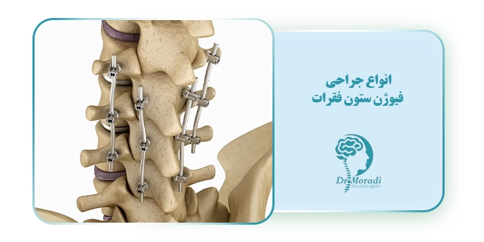 انواع جراحی فیوژن ستون فقرات