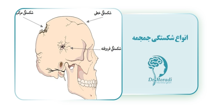 انواع شکستگی جمجمه