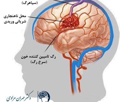 بیماری-AVM-چیست