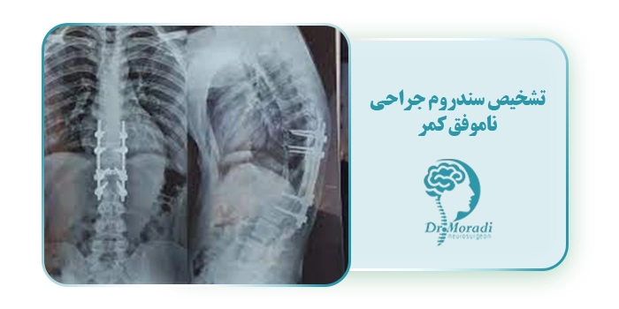 تشخیص سندروم جراحی ناموفق کمر