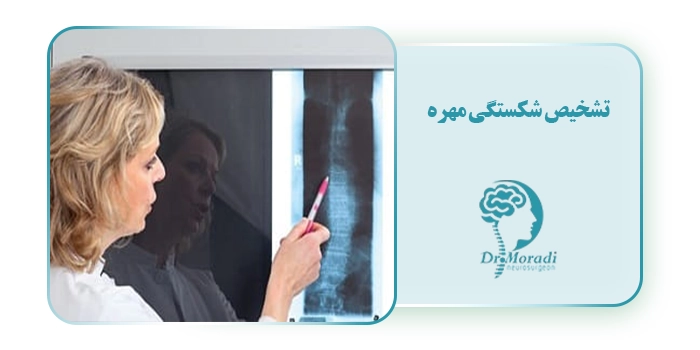 تشخیص شکستگی مهره