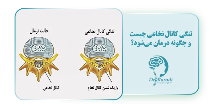 تنگی کانال نخاعی چیست و چگونه درمان می‌شود؟