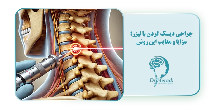 جراحی دیسک گردن با لیزر؛ مزایا و معایب این روش