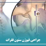 جراحی فیوژن ستون فقرات و اتصال مهره ها بهم
