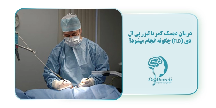درمان دیسک کمر با لیزر پی ال دی (PLD) چگونه انجام میشود؟