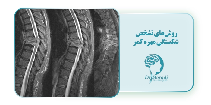 روش‌های تشخص شکستگی مهره کمر