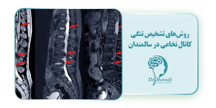 روش‌های تشخیص تنگی کانال نخاعی در سالمندان