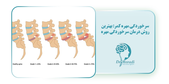 سرخوردگی مهره کمر: بهترین روش درمان سرخوردگی مهره