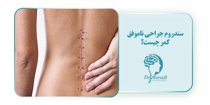سندروم جراحی ناموفق کمر چیست؟