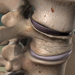 شکستگی فشاری ستون فقرات