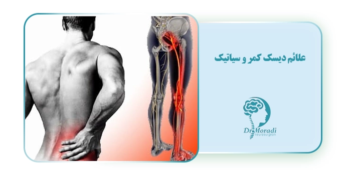 علائم دیسک کمر و سیاتیک