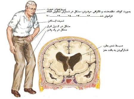 علائم هیدروسفالی
