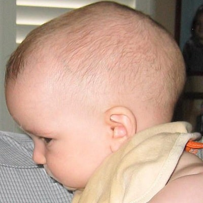 علائم کرانیوسیناستوز