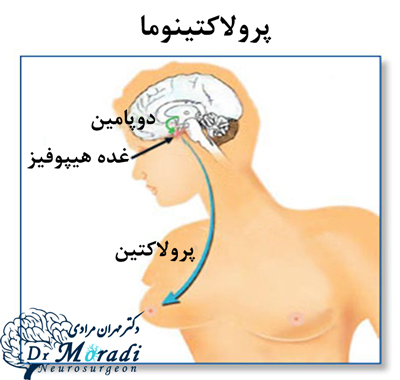 علت بالا بودن پرولاکتین